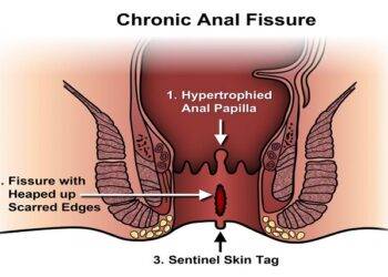 Anal Fissures: Causes & Treatment