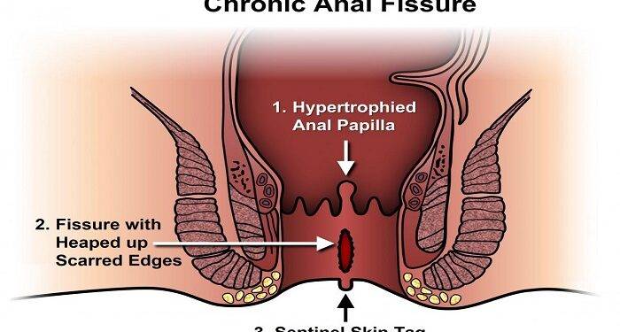 Anal Fissures: Causes & Treatment