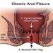 Anal Fissures: Causes & Treatment