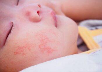 What should I do if my newborn is allergic to milk?